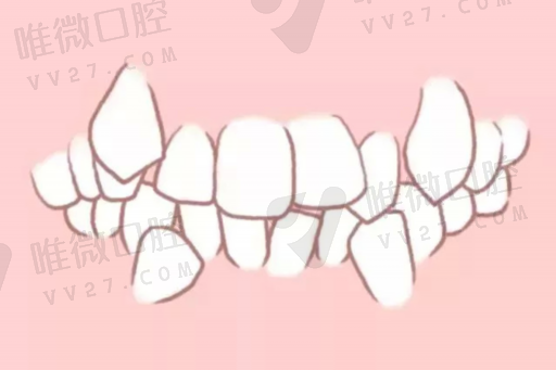 什么是牙齿嵌体治疗（给牙做嵌体是怎么回事）(图1)
